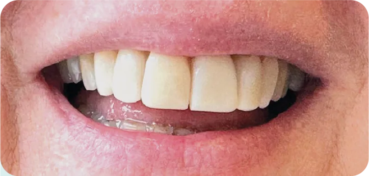 Sourire après pose de facettes dentaires Weneers