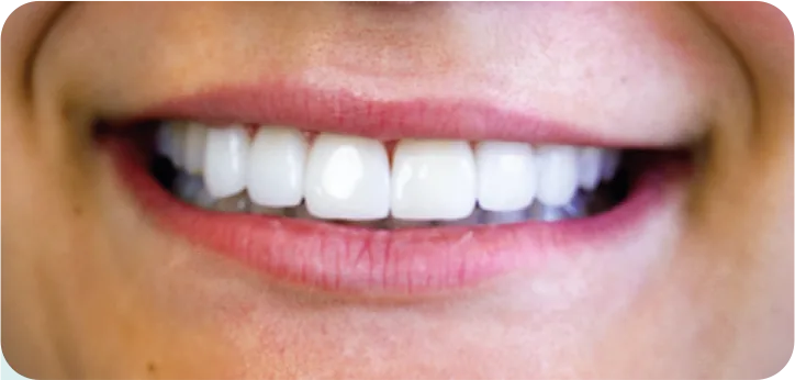 Sourire après pose de facettes dentaires Weneers